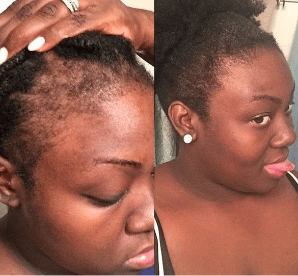 Side-by-side temple hairline photos showing sparse hair on the left and fuller coverage on the right.